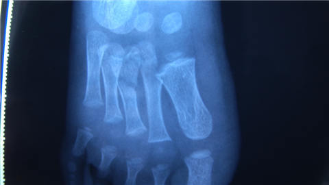 南京3岁男孩被卡电扶梯 右脚骨折皮肤坏死