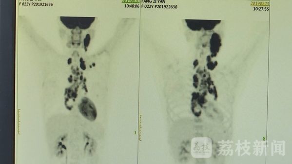 慢淋患者福音！国内首个慢淋诊治中心在南京成立