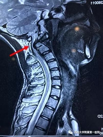磁共振显示高位颈髓严重受压