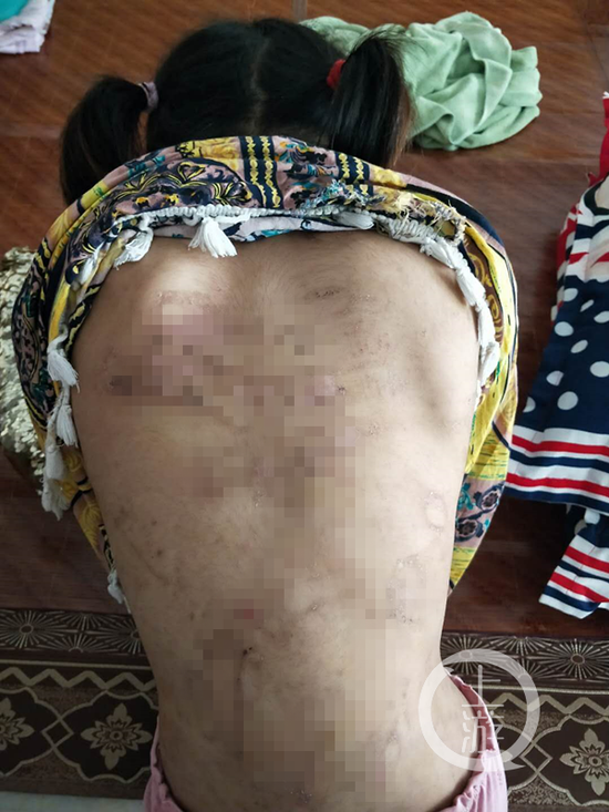 7月17日,江苏邳州8岁女童杨某背上都是伤痕.