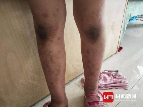 女童被家人吊打满身伤痕 警方:不做作业被母亲打骂