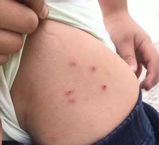 部分学生出现起疹子的症状