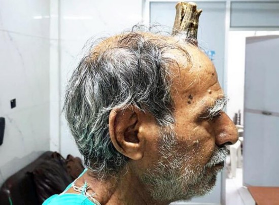 罕见 印度男子头部受伤后长出10厘米犄角