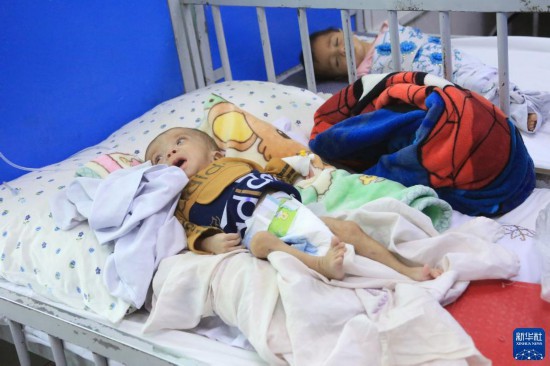 7月10日,营养不良患儿在阿富汗喀布尔英迪拉·甘地儿童健康研究所接受