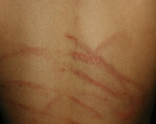 孩子背上有被抽打过的痕迹