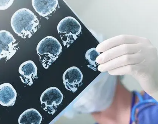 扫描|一次脑扫描就能诊断阿尔茨海默病
