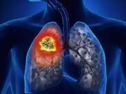 肺癌|空气污染引发非吸烟者肺癌的机制确定